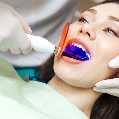 Tẩy trắng răng bằng đèn Plasma - Công nghệ được ưa chuộng nhất