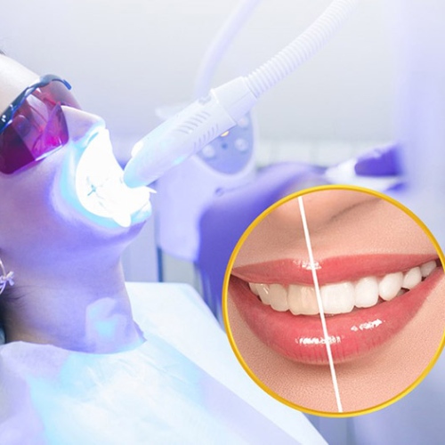 Nano S-White - Công nghệ tẩy trắng răng tân tiến