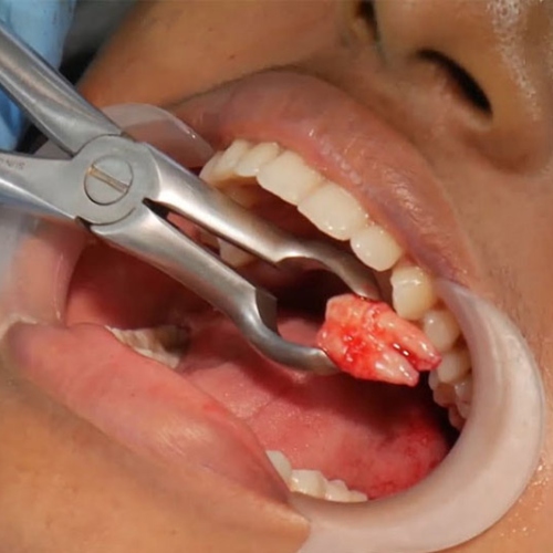 Trường hợp răng khôn mọc ngầm, nha sĩ bắt buộc phải nhổ bỏ