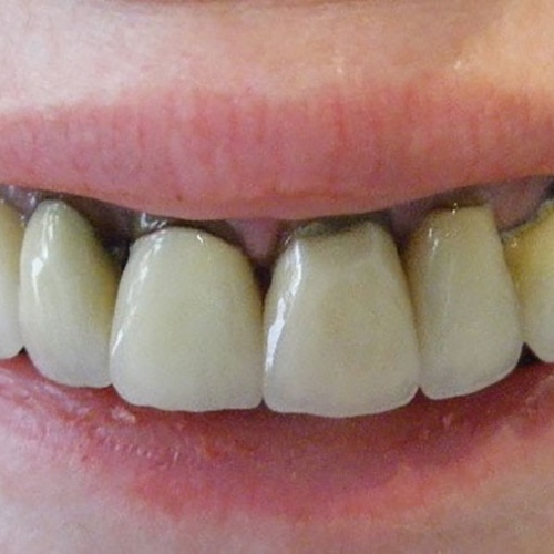 Đen viền nướu - Hậu quả bọc răng sứ sai cách 