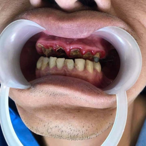 Mất răng vĩnh viễn do bọc răng sứ kém chất lượng 