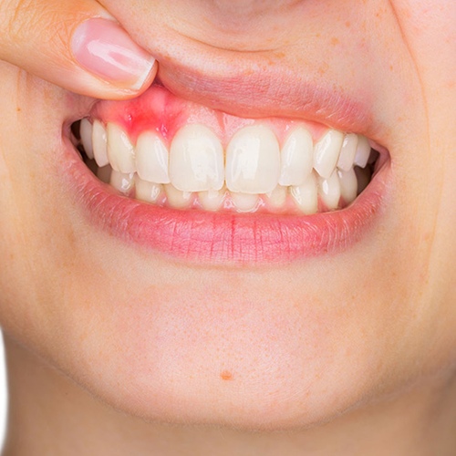 Viêm nướu lợi - Tác hại nguy hiểm của bọc răng sứ giá rẻ
