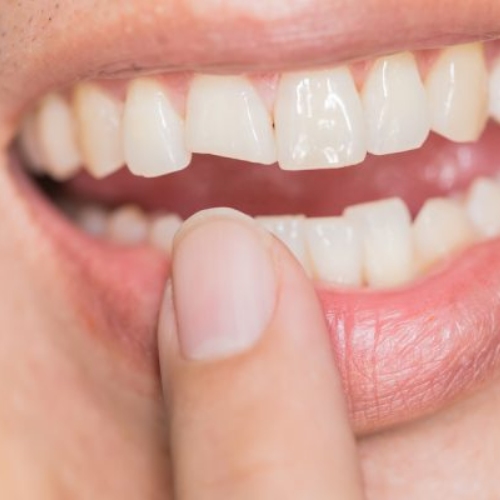 Răng sứ nứt vỡ sau một thời gian sử dụng do vật liệu kém "bền"