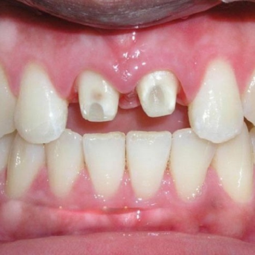 Răng sứ bị rớt ra ngoài để lộ cùi răng thật bên trong 