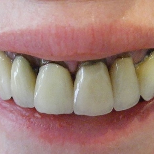 Răng sứ bị ố vàng do chất lượng không đảm bảo