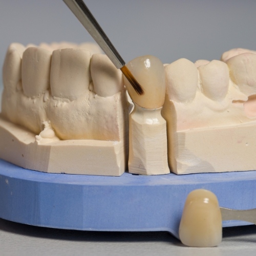 Răng sứ Zirconia và Cercon đều là những lựa chọn chất lượng