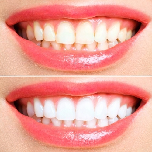 Tẩy trắng răng được bao lâu phụ thuộc vào phương pháp điều trị