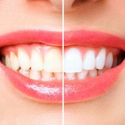 Tẩy trắng răng giúp khắc phục tình trạng răng xỉn màu