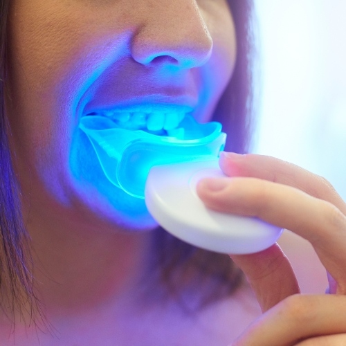 Tẩy trắng răng bằng thiết bị tại nhà