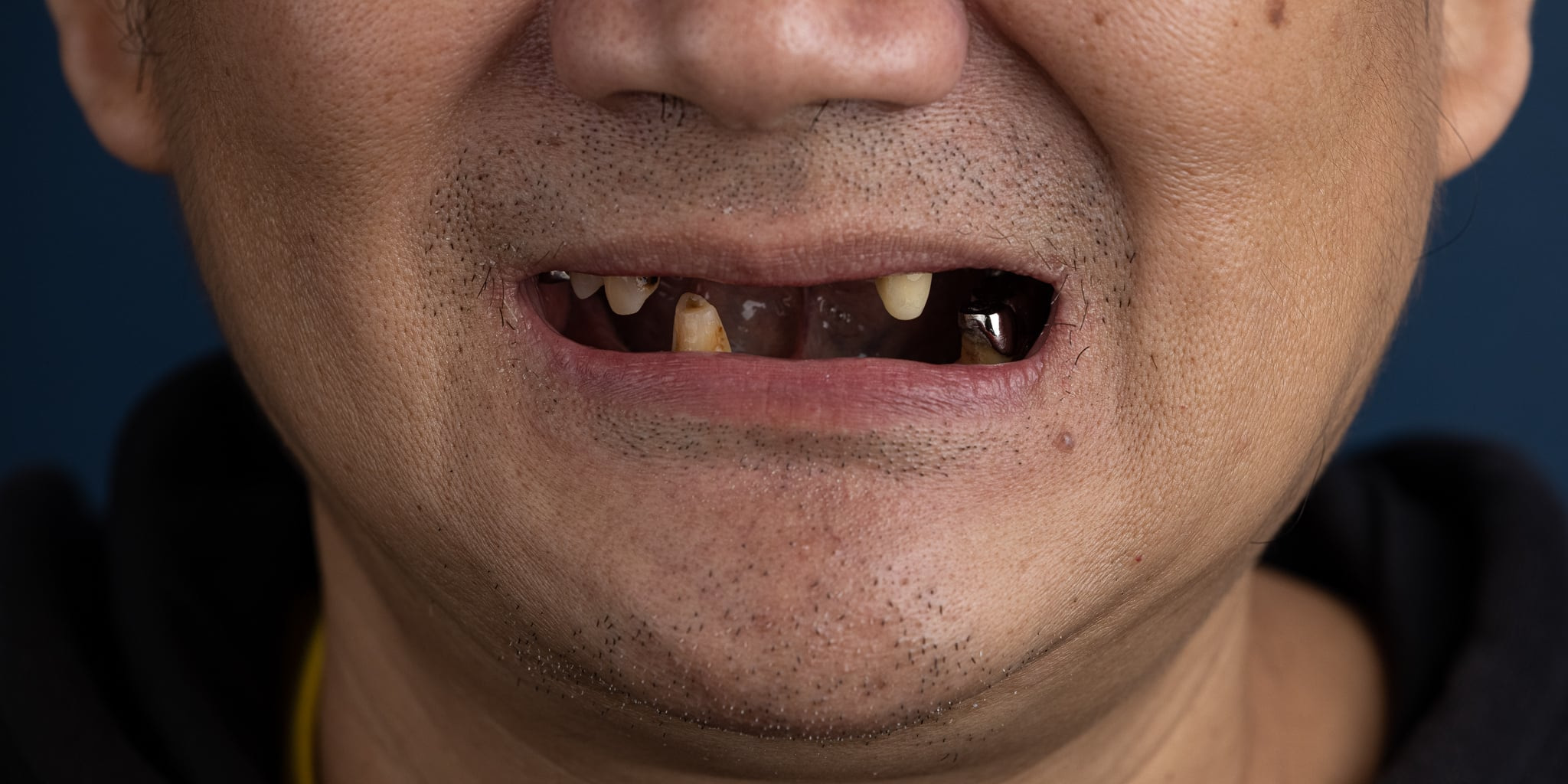 Tình trạng của bác Kha trước khi trồng răng