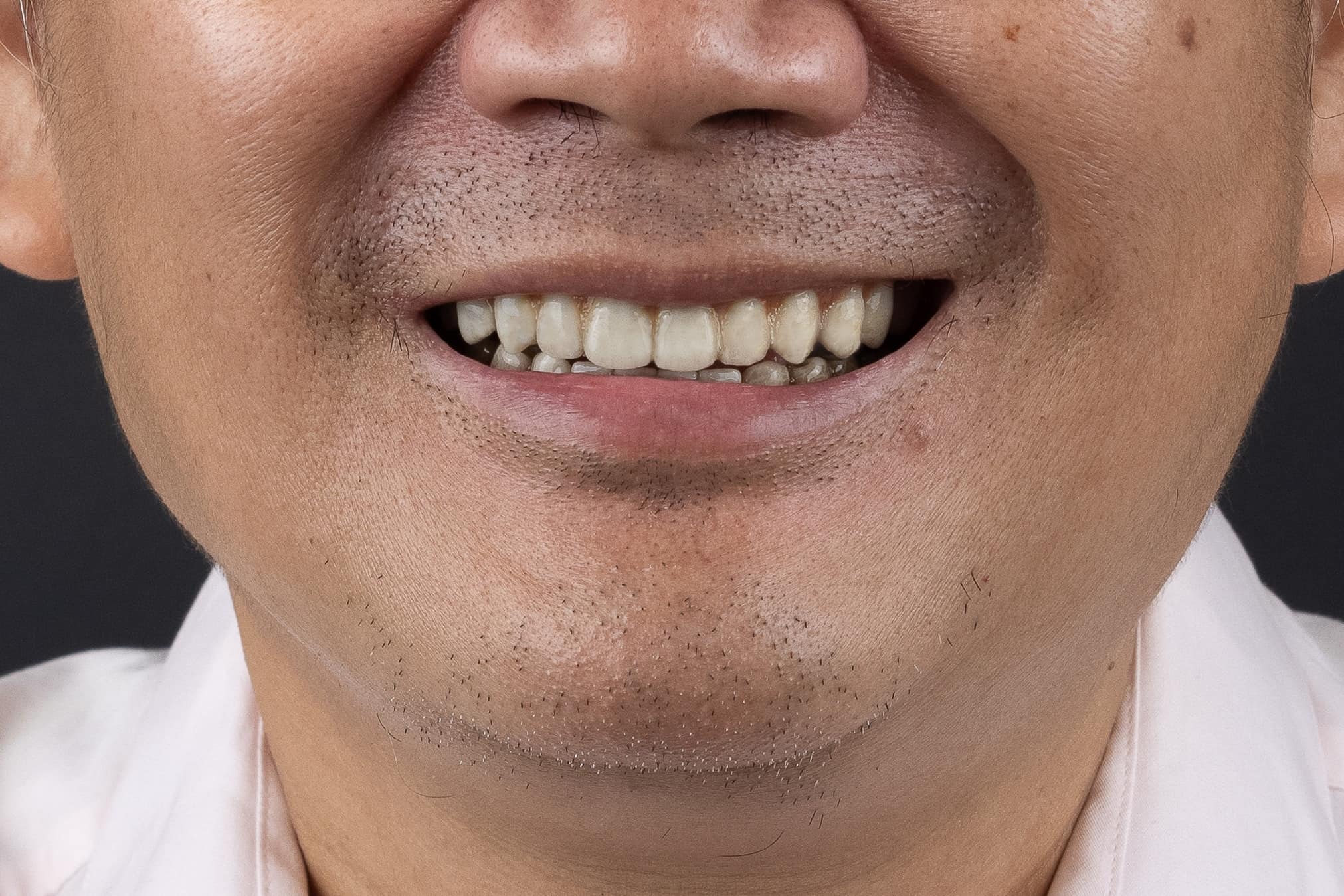 Kết quả sau trồng răng của bác Kha sau khi trồng răng implant tại ViDental