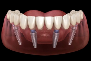 Bảng giá trồng răng Implant All On 4
