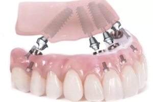 Bảng gái trồng răng Implant All on 5