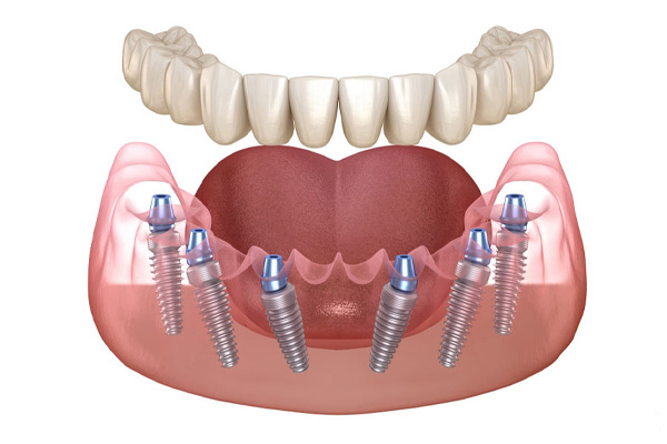 Trồng Răng Implant