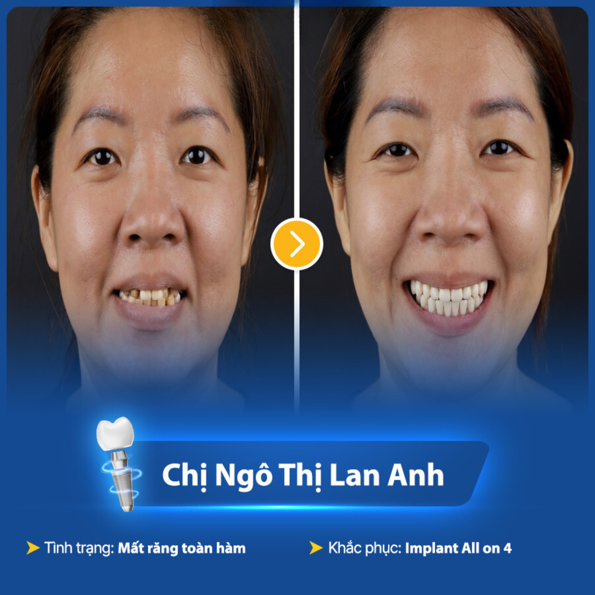 Tình trạng răng của chị Lan Anh trước và sau khi trồng răng bằng công nghệ từ tính tại ViDental 